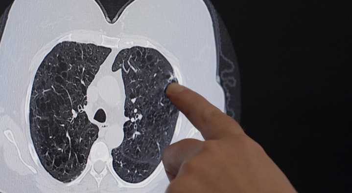 Tulsa lung cancer survivor advocates for screenings