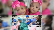 Watch: Jamaican conjoined twins separated in complex surgery in Saudi Arabia