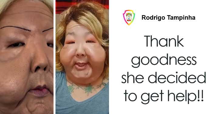 Influencer Disfigured In Botched Plastic Surgery Undergoes New Operation To Restore Her Look