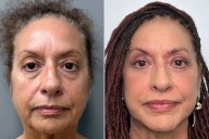 Woman, 70, Spends 8 Hours Getting Plastic Surgery — See Before