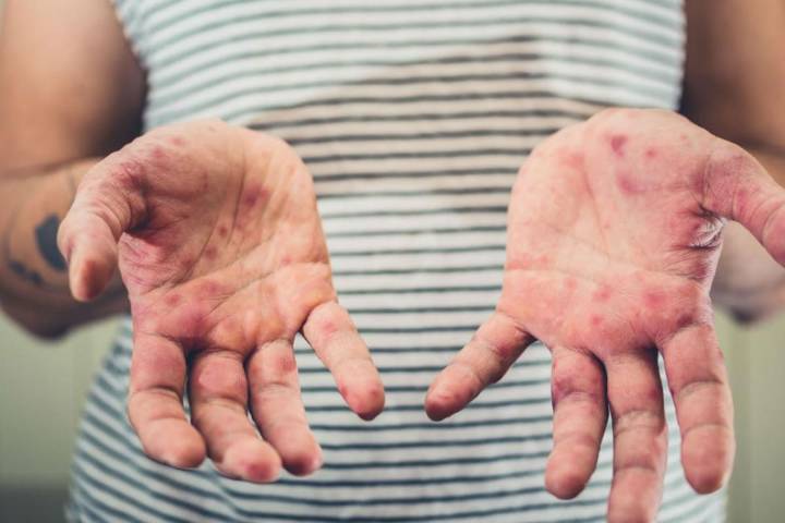 Alerta sarampión. El mapa del recorrido que hizo la familia contagiada a bordo de tres ómnibus de larga distancia