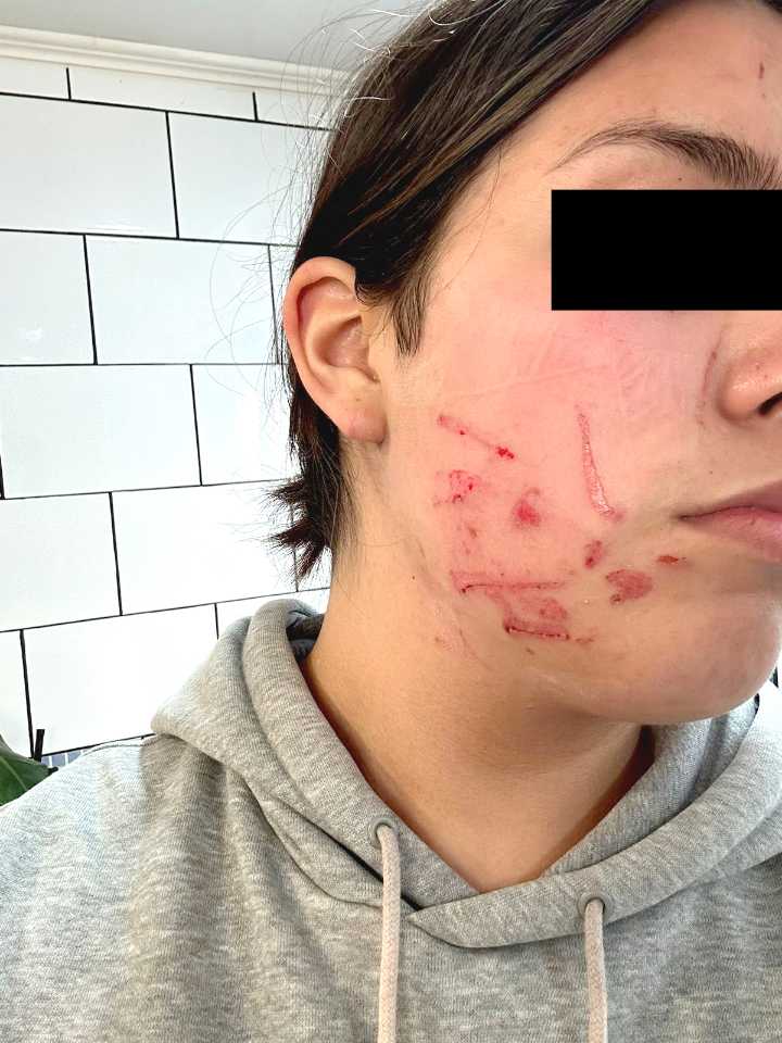 Madre denuncia que estudiante desfiguró el rostro de su hija