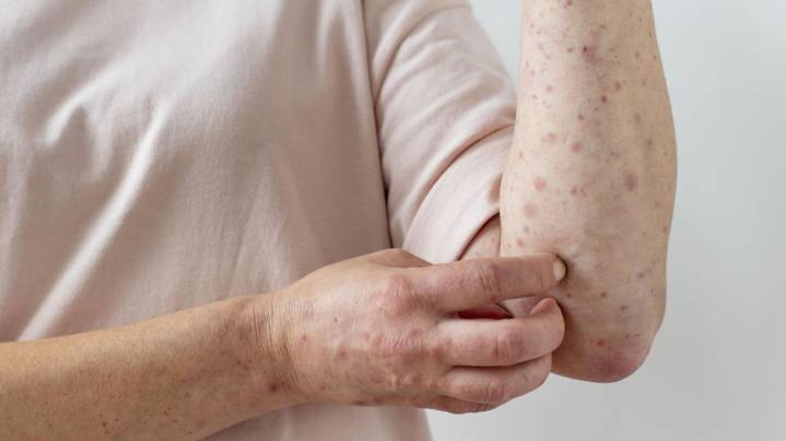 El Gobierno de la provincia de Buenos Aires encendió las alarmas ante un nuevo brote de sarampión