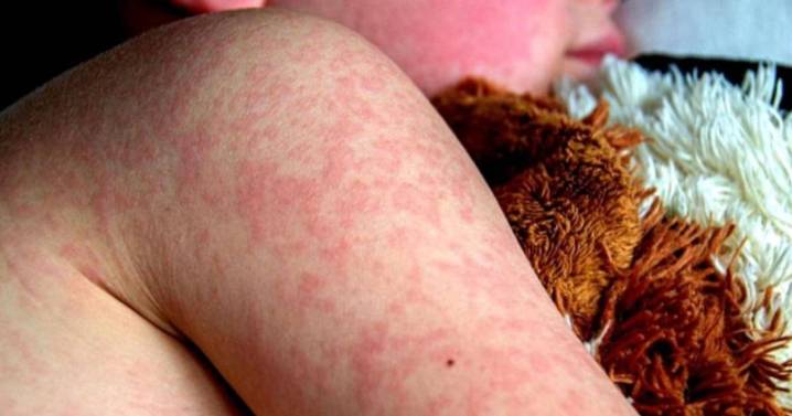 Sarampión: Instan a mantener al día el carnet de vacunación