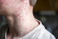 New measles case reported in Upstate, 47 total cases in 2025