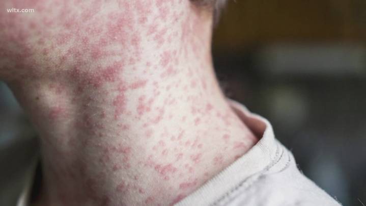 Eight new measles cases reported in South Carolina Upstate, DPH says