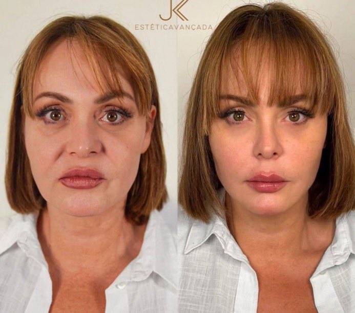 FOTO: El impresionante rejuvenecimiento facial que logró Gaby Spanic tras procedimiento estético en Brasil