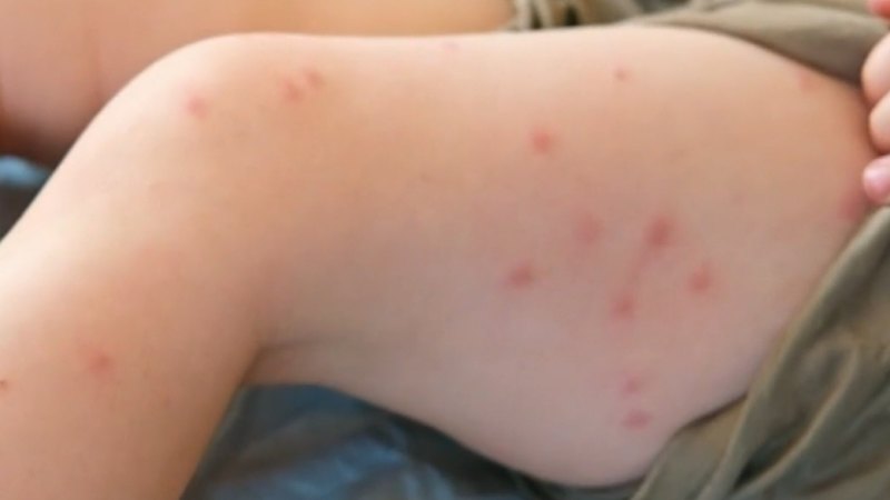 Measles alert issued after US singer’s concert