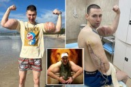 Freakish 'Popeye' who injected his biceps could now lose both arms