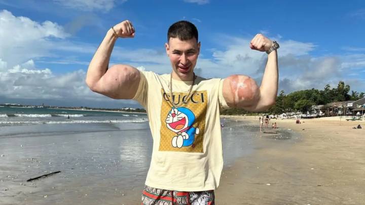 El 'Popeye ruso' podría sufrir la amputación de ambos brazos tras años de inyecciones descontroladas para aumentar sus bíceps