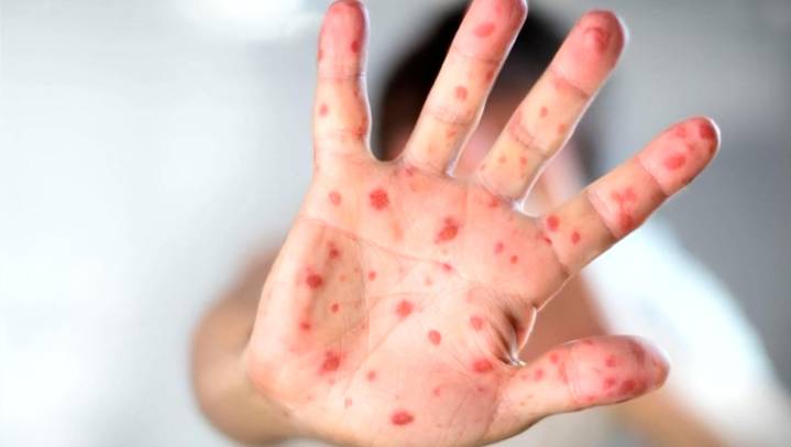 Edomex registra 5 casos de sarampión tras estudiar 519 sospechosos