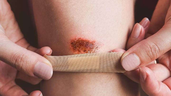 Por qué NO debes usar alcohol en las heridas y qué hacer para desinfectarlas