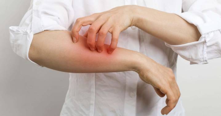 Scabies outbreak sweeps across Devon as more schools with cases