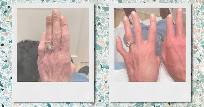 This Treatment Made My Hands Look 20 Years Younger in One Appointment