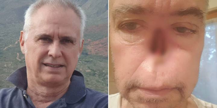 Le extirparon la nariz por un tumor y, tras múltiples cirugías, recuperó su imagen: la larga lucha de Juan Casá por aceptar su nuevo rostro