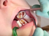 Causas y tipos de traumatismo dental