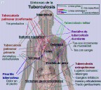 La tuberculosis es curable