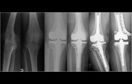 TKA Enhances Mobility and Quality of Life in Ankylosed Knee Patients Despite Higher Complication...