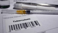 India logged highest number of TB cases in 2024: WHO report