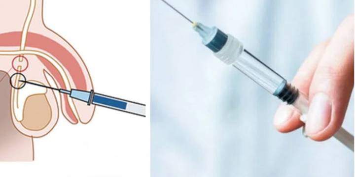 Vasectomía: las dudas más comunes de los hombres sobre este procedimiento