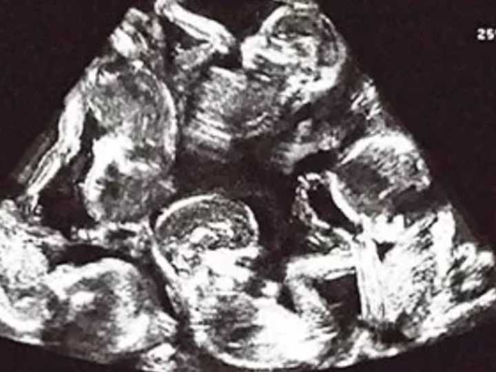 Sorpresa médica: una mujer descubrió que está embarazada de 9 bebés