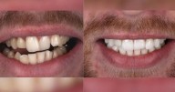 Shoppers can save £500 off 'amazing' dentist teeth whitening for Black Friday