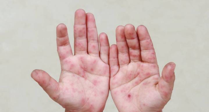 Virus Coxsackie en niños de Apodaca es estacional: Salud