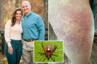 Alpha-gal syndrome from a tick bite made me allergic to meat products — my life is a living hell