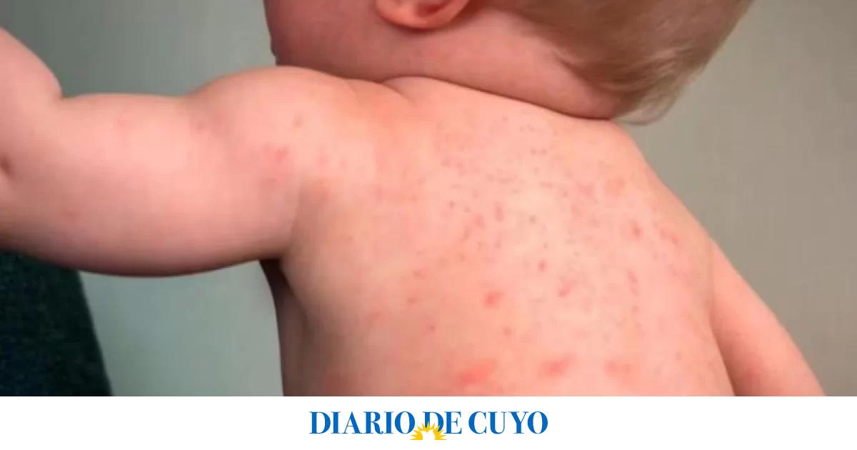 Alerta epidemiológica por nuevos casos de sarampión en Argentina