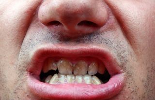 Severe Dental Disease in Substance Use Disorders