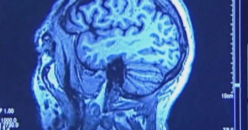 New research may help Alzheimer's patients preserve social memory