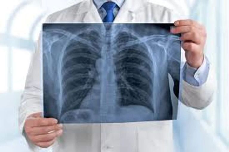 Día Mundial del Cáncer de Pulmón: alertan sobre el aumento de casos