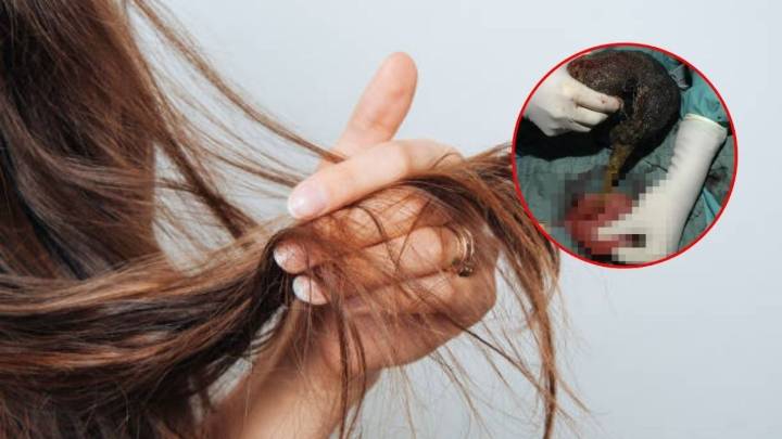 Niña de 10 años es operada para extraerle una bola de pelo de 283 gramos del estómago