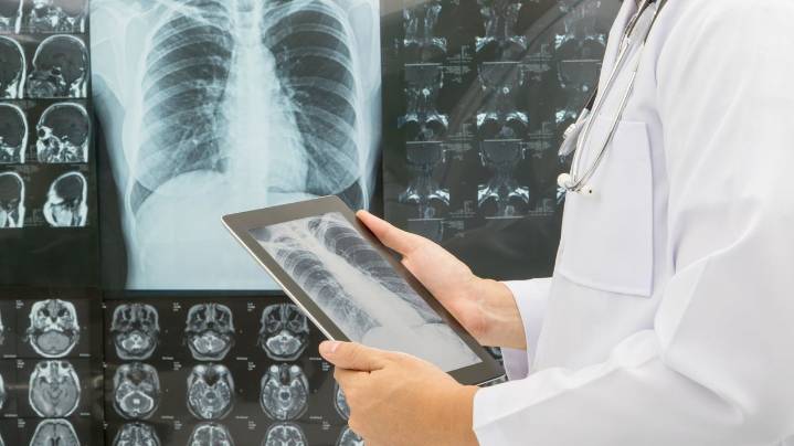 España es el país europeo en el que más crece el cáncer de pulmón femenino