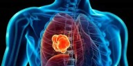 Descubra la proteína que impulsa el crecimiento del cáncer de pulmón