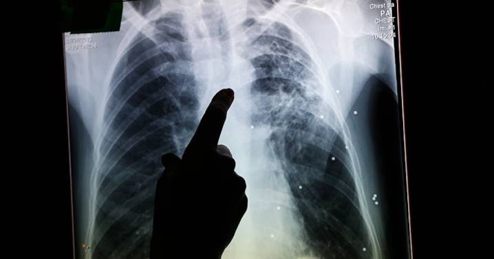 Tuberculosis outbreak declared in Edmonton’s inner