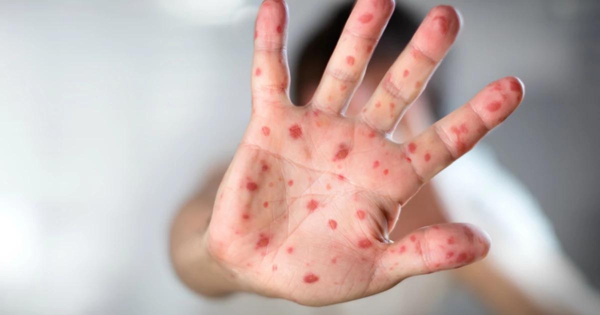 Se disparan casos de sarampión en México; supera 5 mil contagios y 23 muertes este año