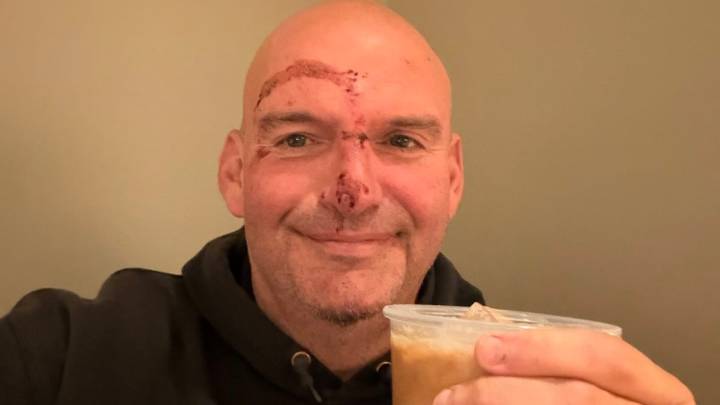Sen. John Fetterman posts picture of injured face after fall