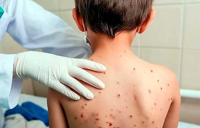 Confirma Salud 23 muertes por sarampión en México