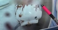 Man has surgery after getting ceramic mug stuck up his bum