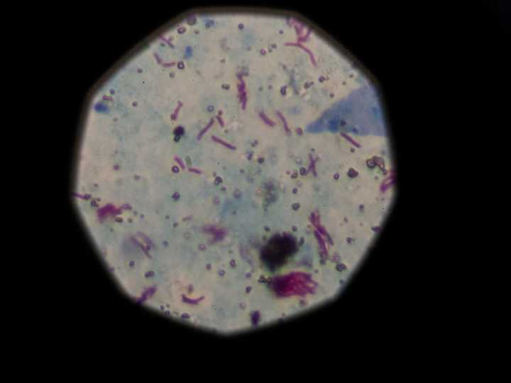 La vacuna contra la tuberculosis: todo lo que debes saber