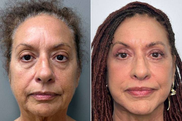 Woman, 70, Spends 8 Hours Getting Plastic Surgery — See Before