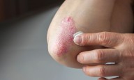 Patients with coexisting psoriasis and diabetes face elevated all