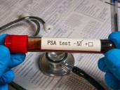 Prostate cancer screening: Committee says no to testing all men