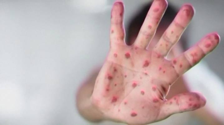 DPH confirms new measles case in Upstate outbreak, bringing total to 44