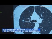 Northwestern University study recommends expanding lung cancer screening ages