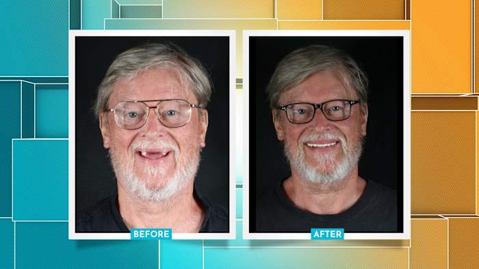 For your health: Restore your smile in one day with one procedure