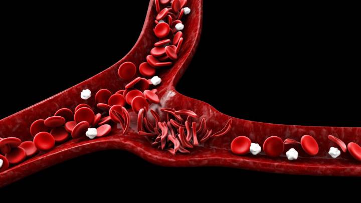 Agios reports mixed results from sickle cell study of Pyrukynd