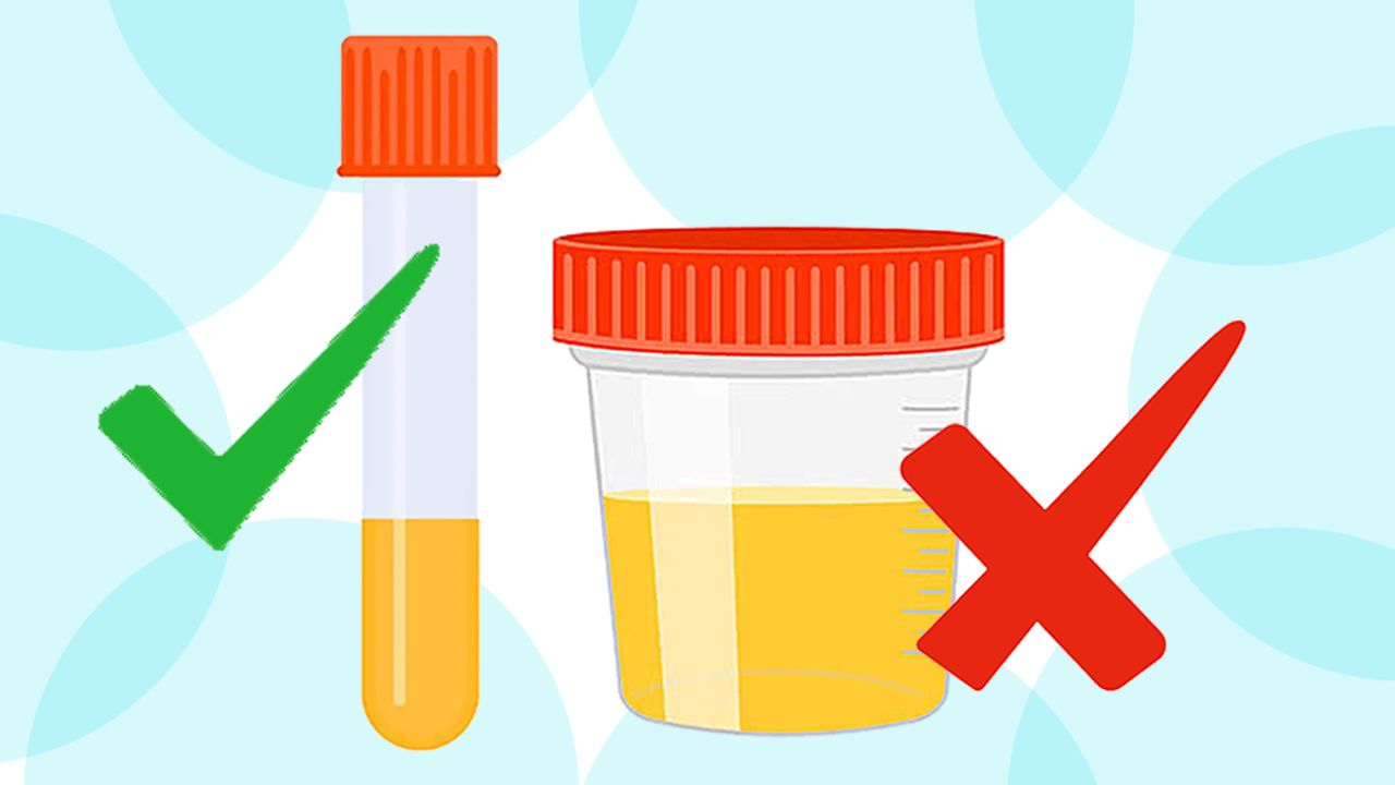 Recogida de orina: pequeño cambio con gran impacto en la analítica