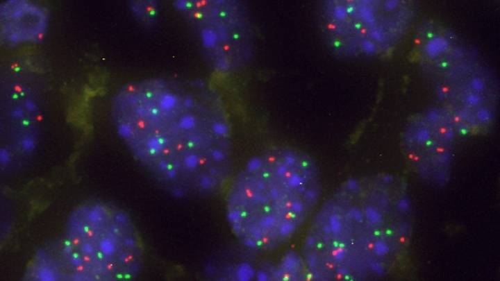 Una proteína actúa como barrera natural frente al avance del cáncer de pulmón más agresivo